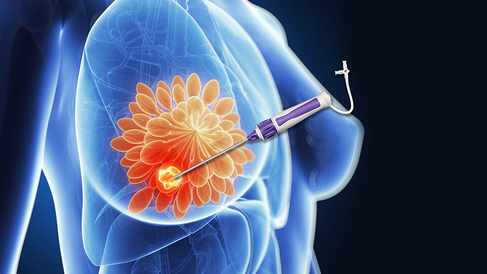 Tumor Ablation